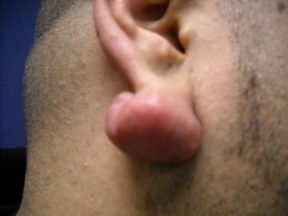 Chicago keloid removal